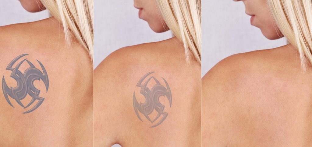 Derma Medica - Erase your unwanted tattoos in the most effective way with  our Pico Laser Tattoo Removal. It is a safe and effective procedure of  applying laser technology deep into the